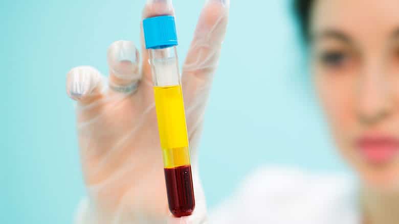 PRP Therapy